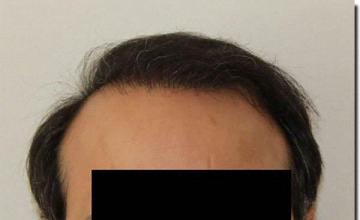 Hair restoration procedure results