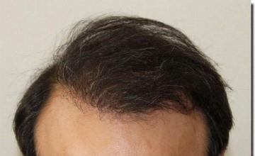 Hair restoration procedure results