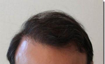 Hair restoration procedure results