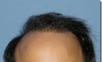 Hair restoration procedure results