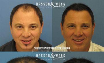 Front view - Before and after hair transplant surgery