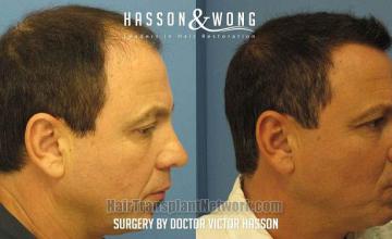 Hair restoration procedure before and after results