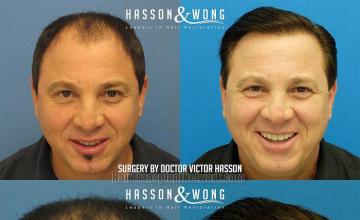 Hair transplant surgery before and after pictures