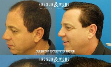 Hair transplant surgery before and after images