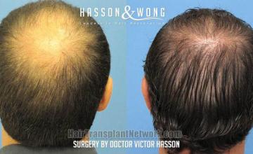 Hair restoration procedure before and after result images