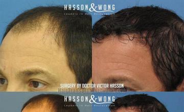 Surgical hair transplantation result photographs