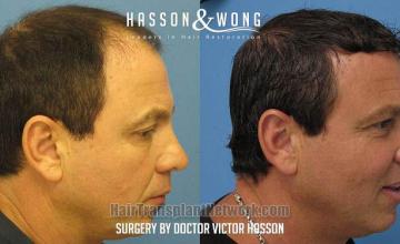 Hair transplant surgery before and after images