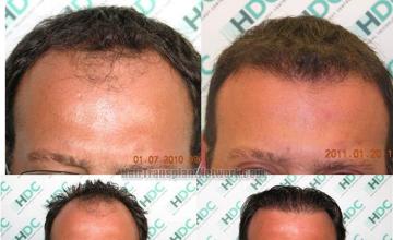 Hair restoration procedure before and after results