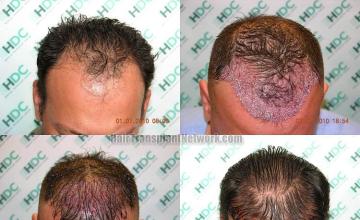 Hair transplantation surgery before and after photos