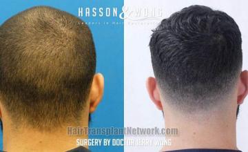 Hair replacement surgery before and after images