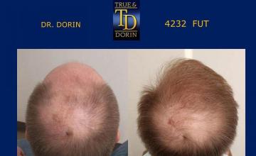 Hair replacement surgery before and after images