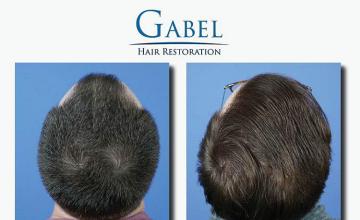 Surgical hair transplantation result photographs