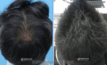 Hair replacement surgery before and after images