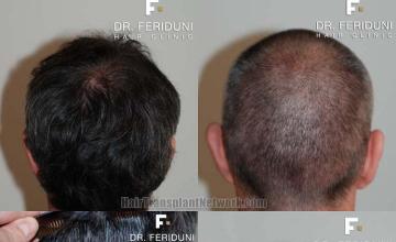 Hair transplantation surgery before and after images