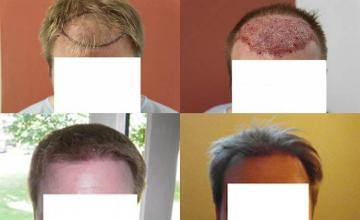 Hair restoration procedure before and after results