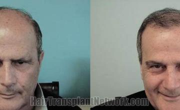 Hair restoration procedure before and after results