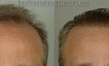 Hair restoration procedure before and after results