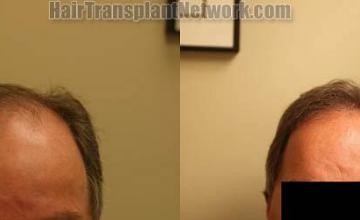 Hair restoration procedure before and after results