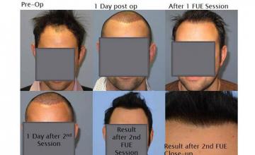 Hair restoration procedure before and after results