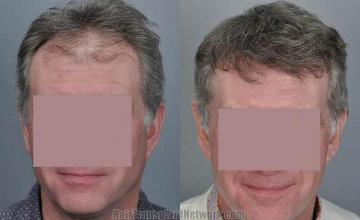 Hair transplantation surgery before and after photos