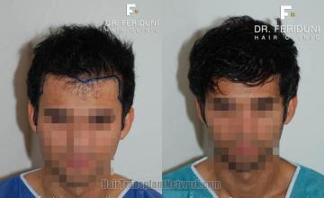 Before and after hair transplantation result photographs