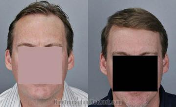 Hair transplantation surgery before and after photos