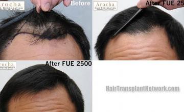 Hair restoration procedure before and after results