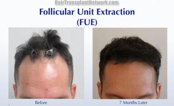 Before and after hair transplant procedure images