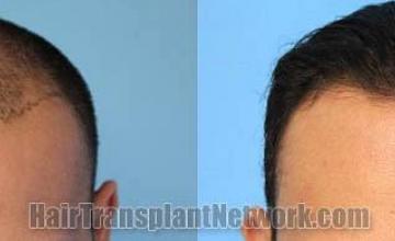 Hair restoration procedure before and after results