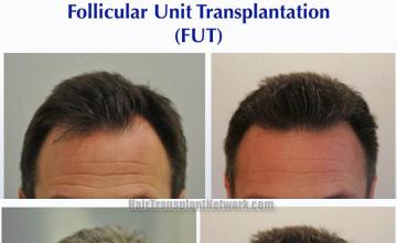 Before and after hair transplant procedure images