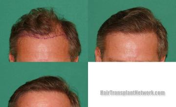 Front view - Before and after hair transplantation surgery