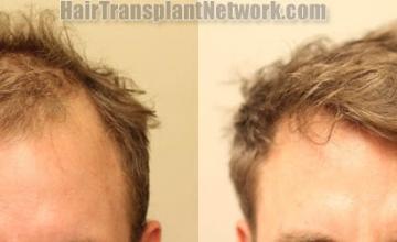 Front view - Before and after hair restoration procedure