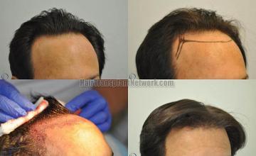 Hair transplantation surgery before and after images