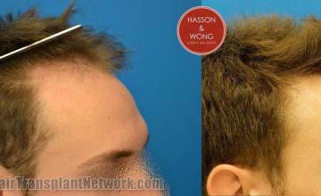 Hair restoration procedure before and after results