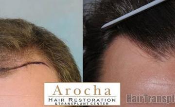 Before and after hair transplant procedure images