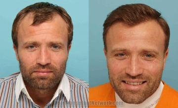 Hair restoration procedure before and after results