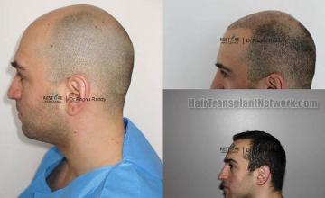 Hair transplantation surgery before and after images