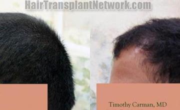 Hair transplantation surgery before and after pictures