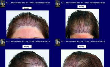 Hair restoration surgery before and after photos