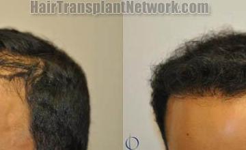 air transplantation surgery before and after images