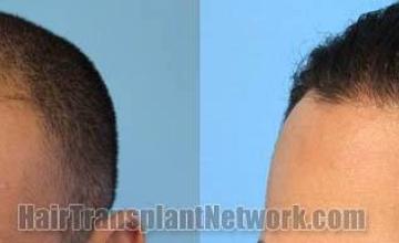 Hair transplantation surgery before and after pictures