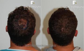 Hair restoration procedure before and after results