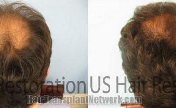 Back view of hair restoration procedure before and after 