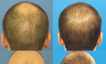 Back / Crown photos of hair transplant results