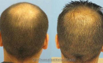 Back view pictures - Before and after hair transplant procedure