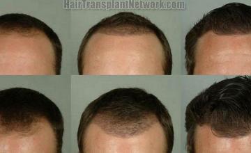 Hair restoration procedure results at six months- Front view