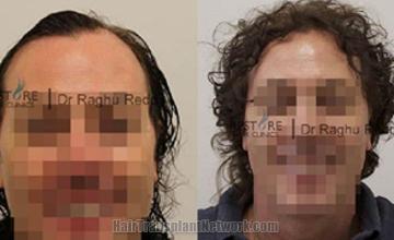 Before and after hair transplant procedure images