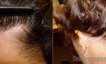 Hair restoration with 1302 grafts on a female patient