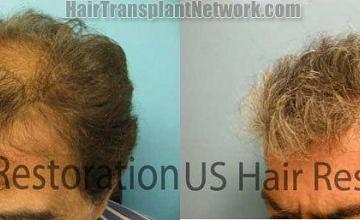 Left view - Hair replacement procedure photos