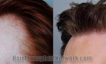 Hair transplantation surgery before and after pictures